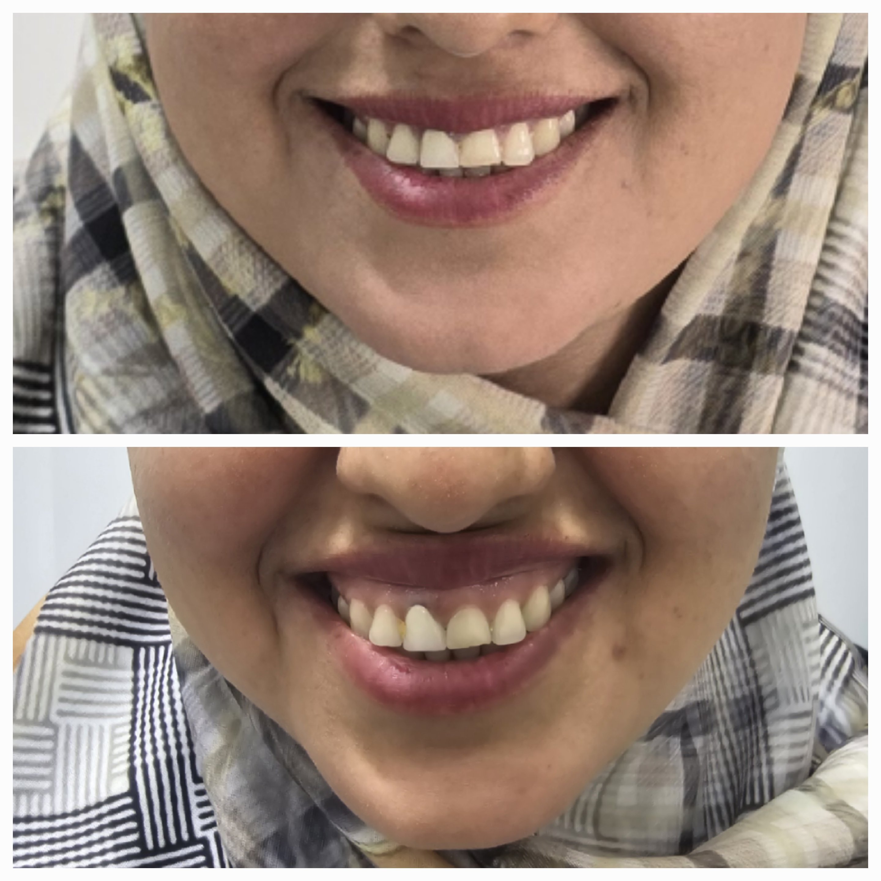 بوتاکس لبخند لثه ای