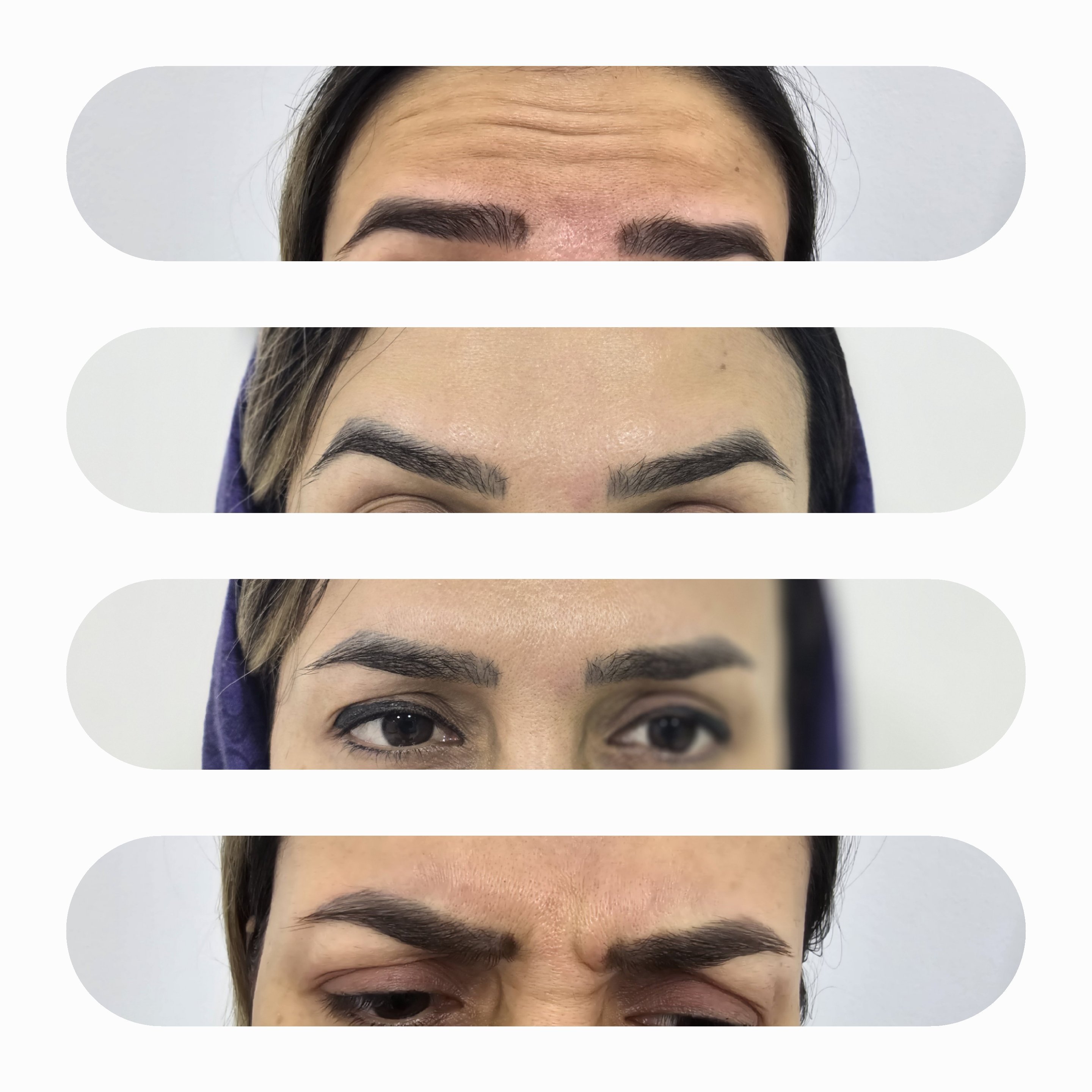 بوتاکس پیشانی