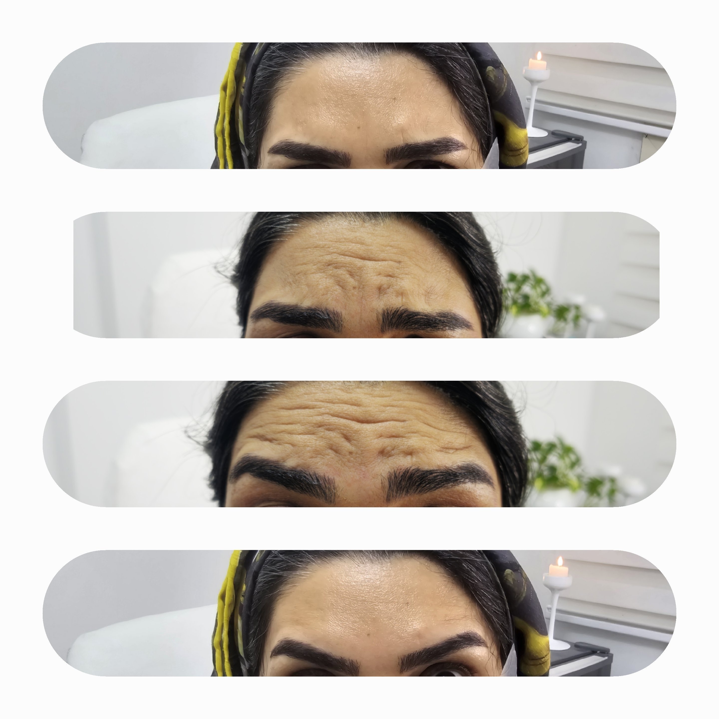 بوتاکس پیشانی