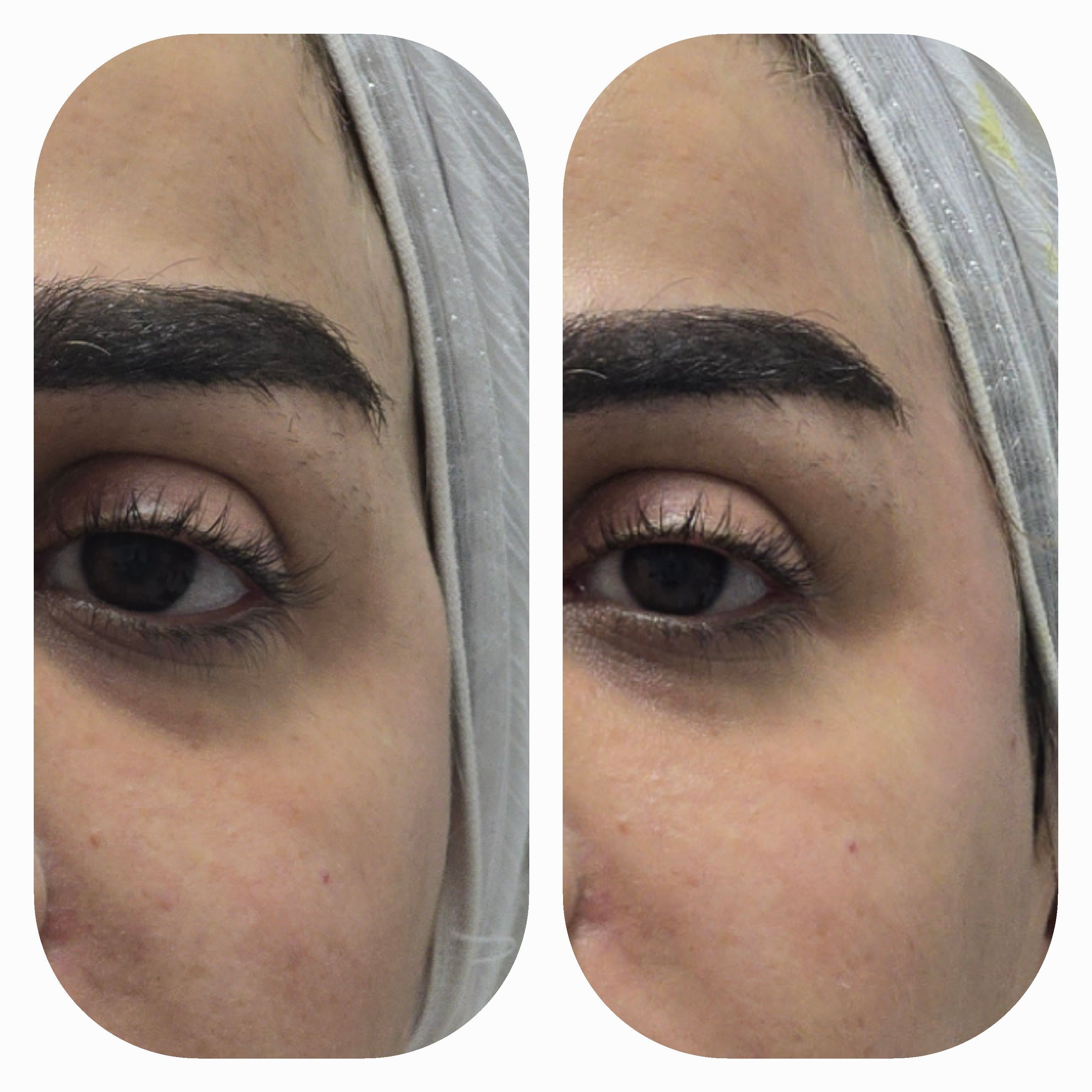 فیلر شقیقه